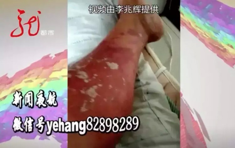 男子按摩之后出現(xiàn)紅腫水皰糜爛！有關(guān)部門(mén)已經(jīng)介入檢查