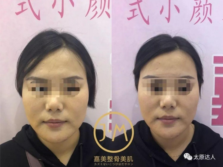太原現(xiàn)！日式整骨小臉術(shù)！大V明星爆紅全靠它~