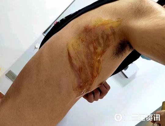 男子在咸陽(yáng)一足浴店拔罐技師不慎引燃酒精致男子燒傷