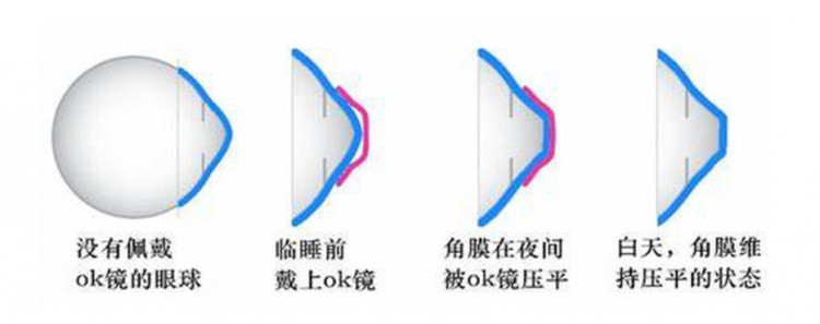 歐普康視——幫眼睛做個(gè)SPA毛利堪比茅臺(tái)
