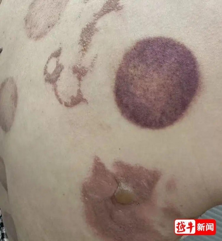 紹興知名足浴店女子拔罐出事了