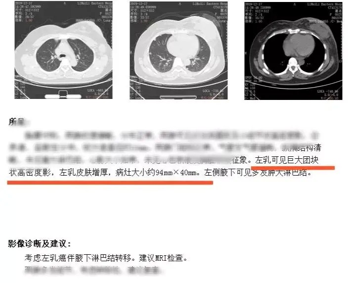 身體發(fā)現(xiàn)腫塊她選擇用按摩消除結(jié)果一年后崩潰了