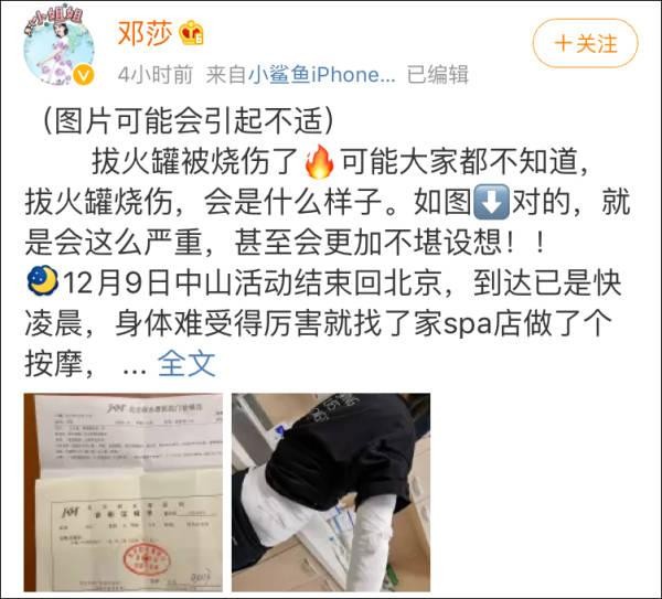 女演員在SPA店拔火罐被嚴重燒傷
