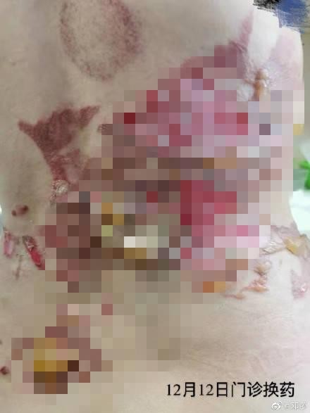 女演員在SPA店拔火罐被嚴重燒傷